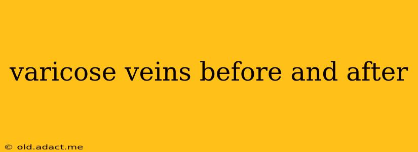varicose veins before and after