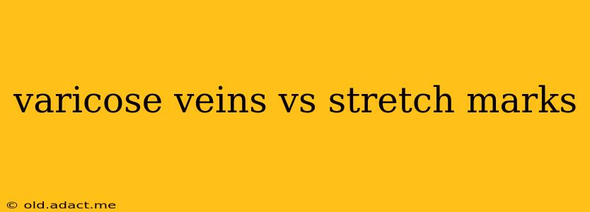 varicose veins vs stretch marks