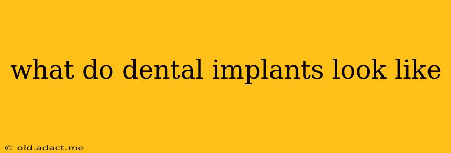 what do dental implants look like