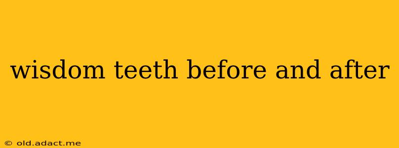 wisdom teeth before and after